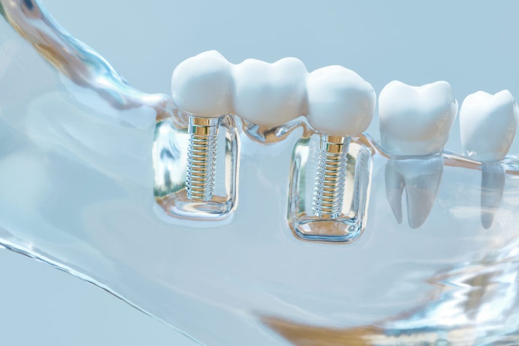 Tooth Replacement Options in Hanover, Maryland 