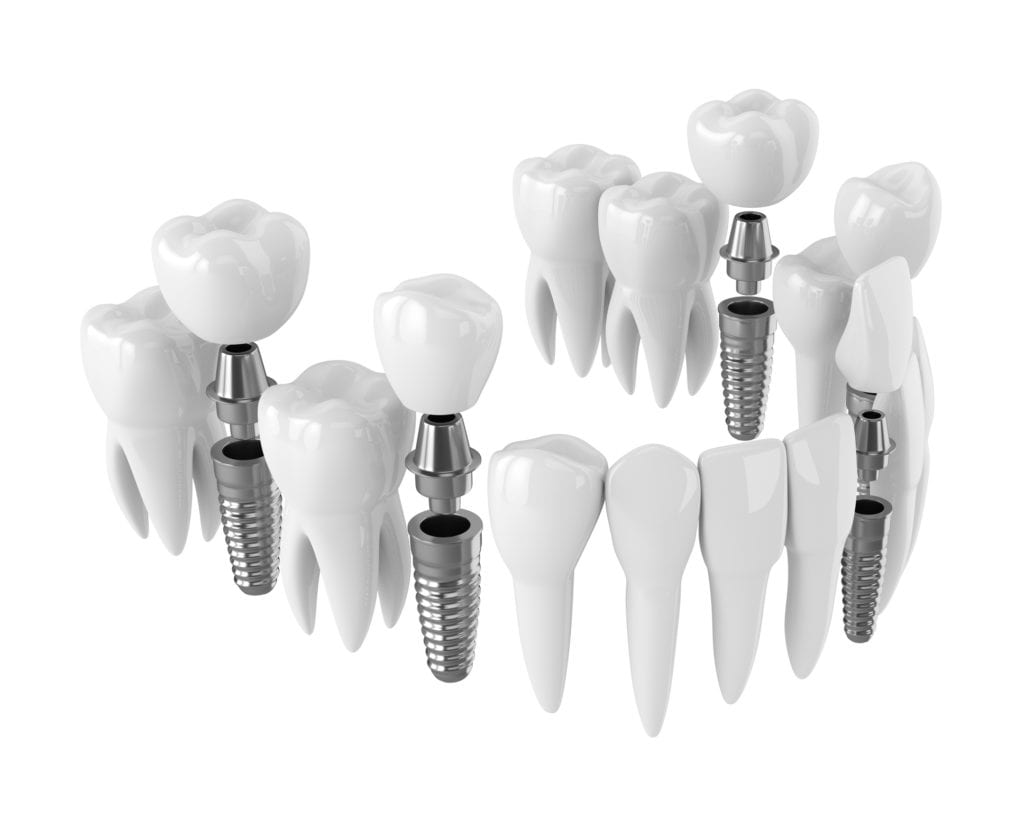 Dental Implants in Hanover, Maryland for missing teeth replacement