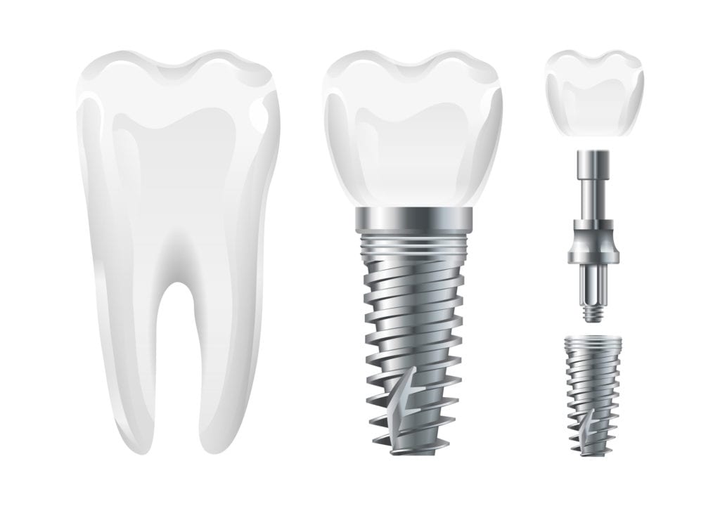 The Structure of a dental implant in hanover, maryland