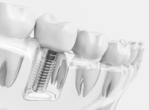 Tooth Replacement Options in Hanover, Maryland 