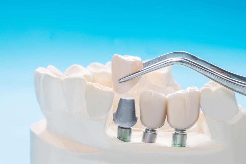 Dental Implant Solutions in Hanover, Maryland