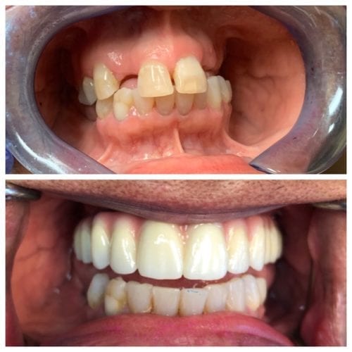Dental Implants results by Elevate Dental Implant Center