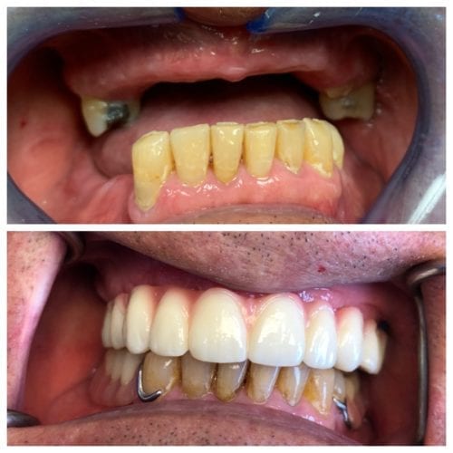 Dental Implants results by Elevate Dental Implant Center