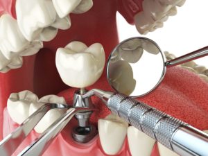 dental implant procedure in Hanover Maryland