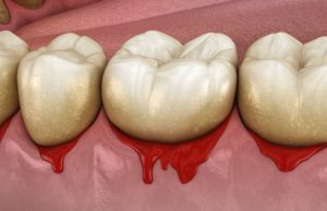 gum disease stages Hanover Maryland