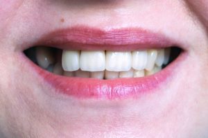 replace missing teeth Hanover Maryland