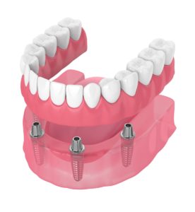 all-on-four dental implant procedure