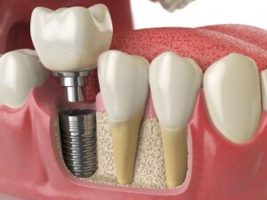 Can a Dental Implant Fail